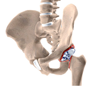 Revision Hip Surgery