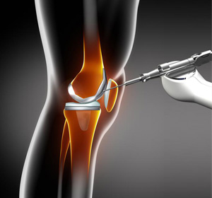 Robotic-Assisted Joint Replacement