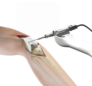 Robotic Assisted Partial Knee Surgery