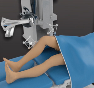 Robotic-Assisted Revision Knee Replacement