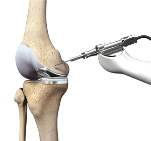 Robotic Unicondylar Knee Replacement