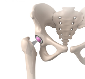 Same Day Hip Replacement
