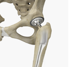Short-Stay and Fast-Track Hip Replacement