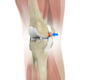 Sprains and Strains