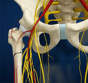 Subtrochanteric Hip Fracture