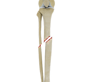 Tibial Shaft Fracture