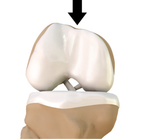 Trochlear Dysplasia