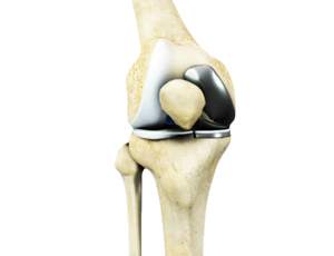 Unicondylar Knee Replacement