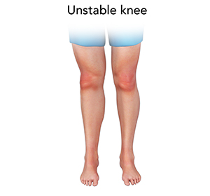 Unstable Knee