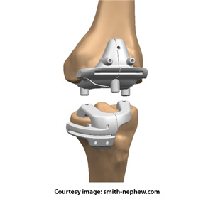 Visionaire Knee Replacement