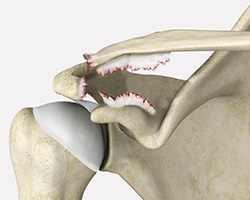 ac joint separation