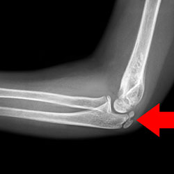 Adolescent Elbow Injuries