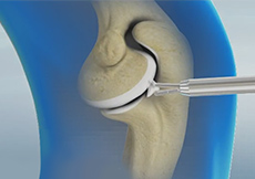 Arthroscopic Debridement of the Elbow
