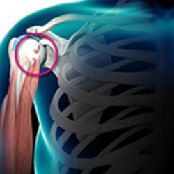 biceps tendon rupture
