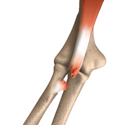 Biceps Tendon Tear