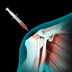 Picture of Bone Marrow Aspirate Concentrate (BMAC) Treatment