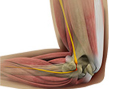 Cubital Tunnel Release