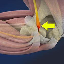 Cubital Tunnel Syndrome