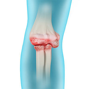 Elbow Arthritis