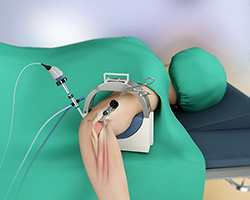 elbow arthroscopy