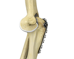 Elbow Fracture Reconstruction
