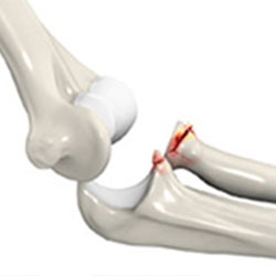 elbow injuries