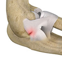 elbow ligament injuries