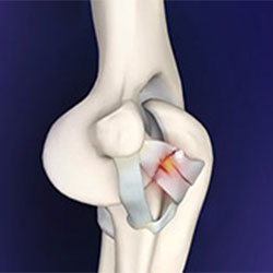 elbow ligament reconstruction