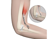 Elbow Tendon and Ligament Repair