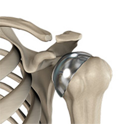 partial shoulder replacement