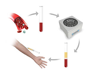 Picture of Platelet-Rich Plasma (PRP) Injection