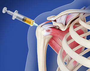Picture of Platelet-Rich Plasma (PRP) Injection