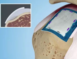 Regeneten Bioinductive Implant