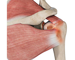 Rotator Cuff Arthropathy