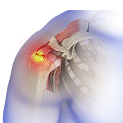 rotator cuff pain