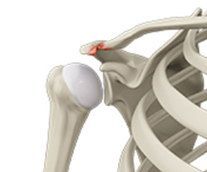 shoulder disorders