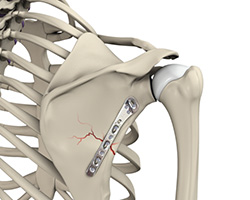 shoulder fracture care