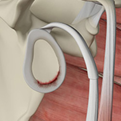 shoulder labral tear
