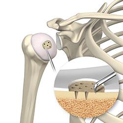 Shoulder Preservation Surgery