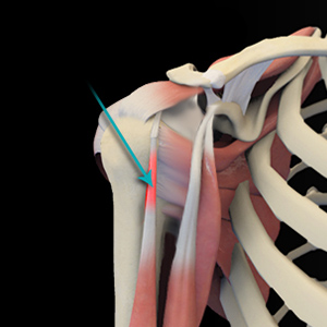 shoulder tendonitis