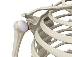 subluxation