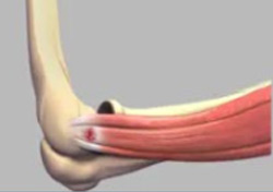 Tennis Elbow