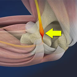 Ulnar Collateral Ligament (UCL) Injury