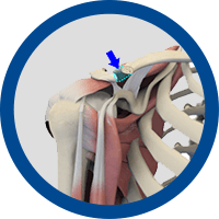 Picture of Failed Prior Shoulder Surgery