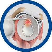 Picture of Labral Tears