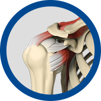 Picture of Rotator Cuff Pathology