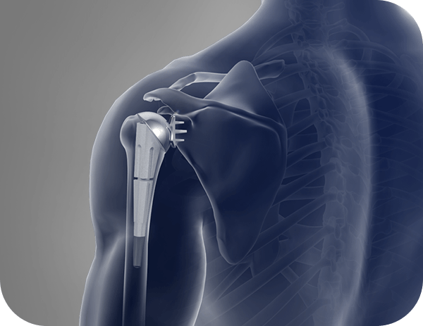 Picture of Shoulder Joint Replacement