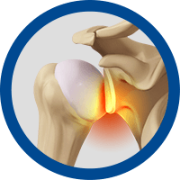 Picture of Shoulder Instability