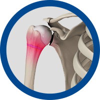 Picture of Stiffness and Motion Issues