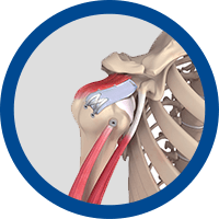 Picture of Thrower’s Shoulder